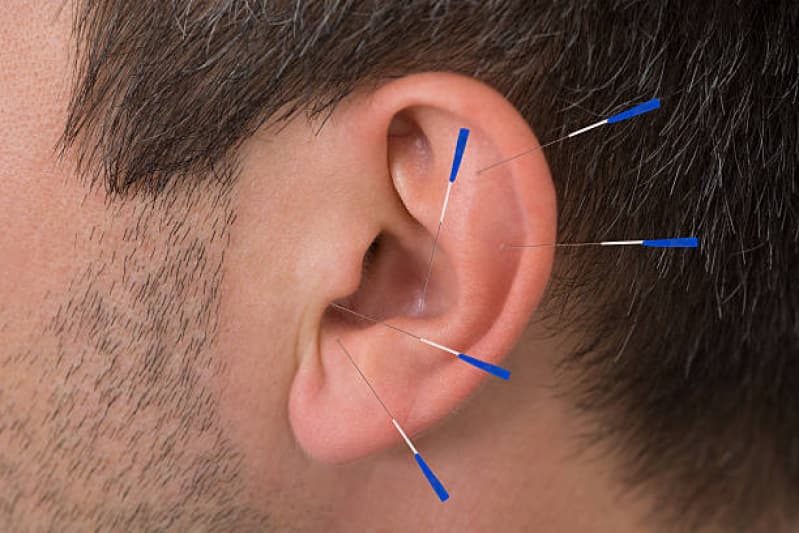 O que é Acupuntura Auricular ou Auriculoterapia?