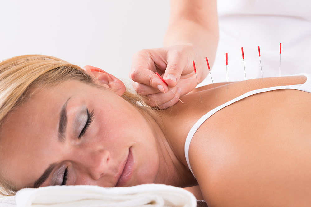 O que é a terapia da acupuntura médica?