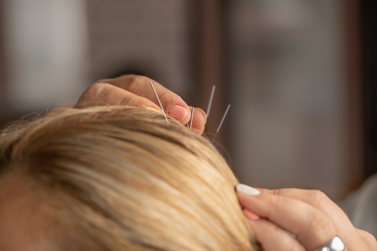 O que é a terapia da Craniopuntura?
