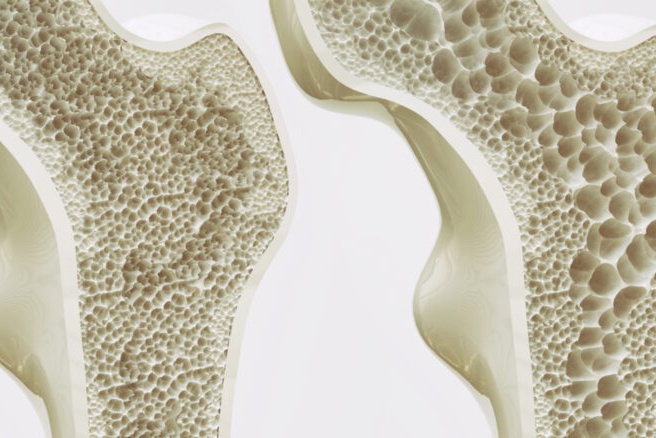 Osteoporose e o Risco Silencioso de Fraturas em Mulheres