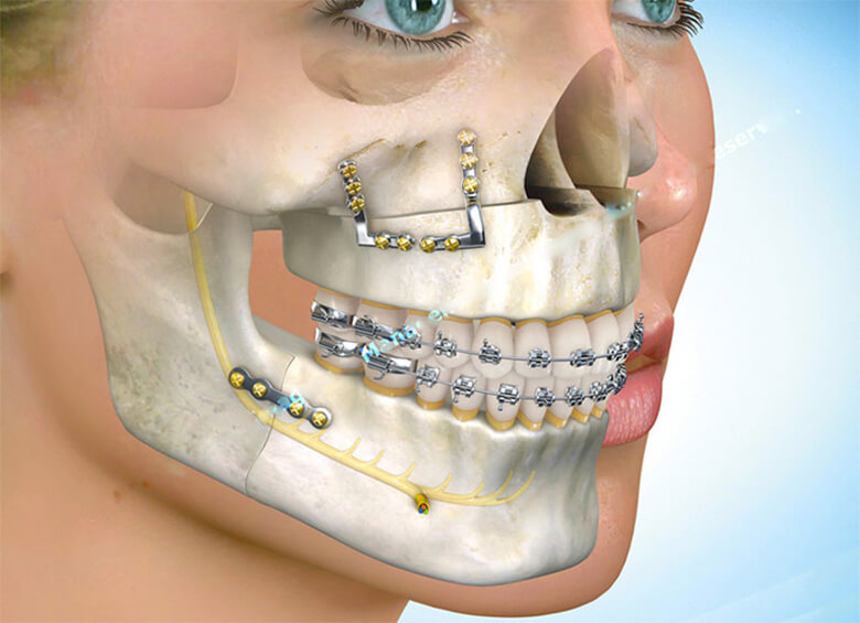 Reconstruindo Sorrisos e Faces: A Cirurgia Bucomaxilofacial