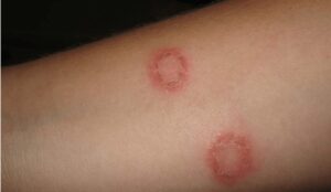 Como Tratar Impingem (Doença contagiosa da pele) de Forma Natural e Segura em Casa