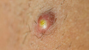 Pimple Extreme Macro with growing hairs