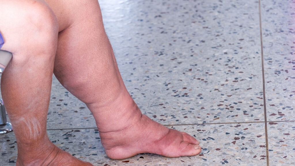 filariasis patient, abnormal lymphatic function patient