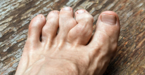 Como Tratar Gota de Forma Natural e Segura em Casa
