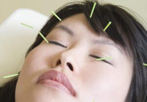 acupuntura-facial-e1663279867577