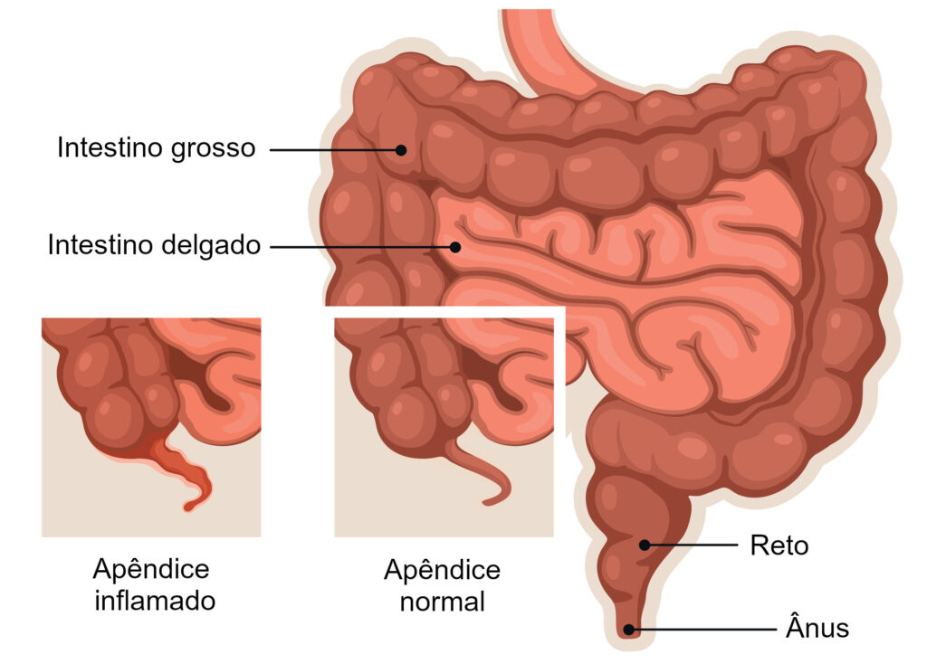apendicite_1648413211