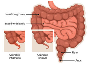 Como Tratar Apendicite de Forma Natural e Segura em Casa