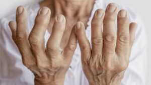 Como Tratar Artrite de Forma Natural e Segura em Casa