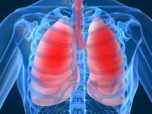Como Tratar Bronquite de Forma Natural e Segura em Casa