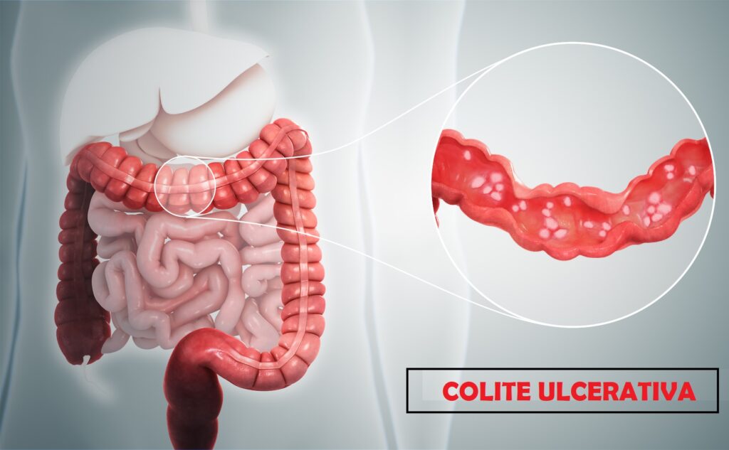 colite-ulcerativa-IGPA