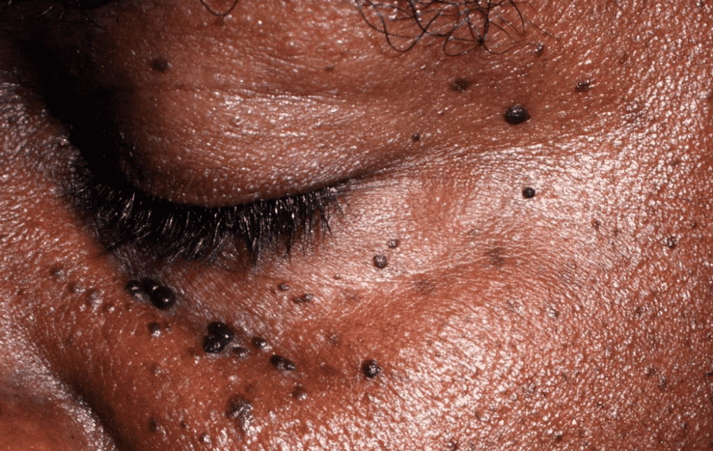 dermatose