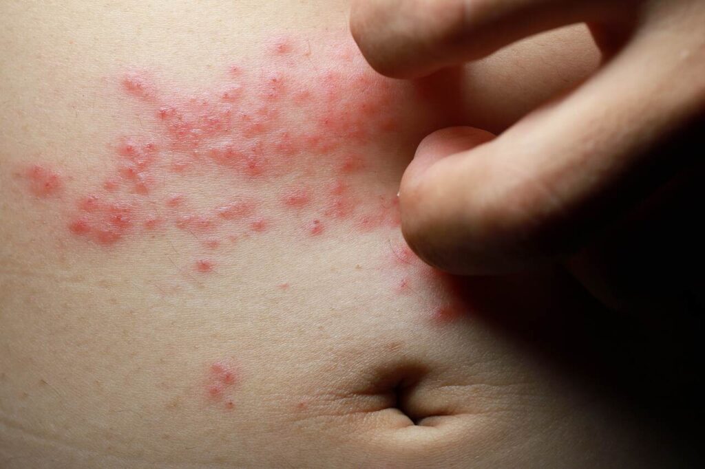 diferenca-alergia-irritacao-cutanea