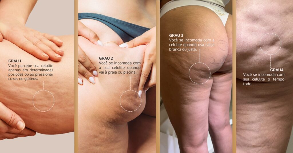 diferentes-graus-de-celulite