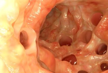 Gostaria de obter mais informações da diverticulite - A forma mais frequente ocorre no intestino...