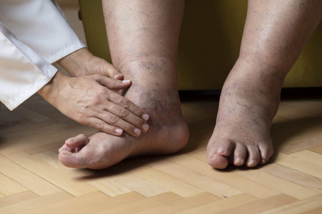 Doctor is examining patients “Cross Over Toe” (Hammertoe) at home.