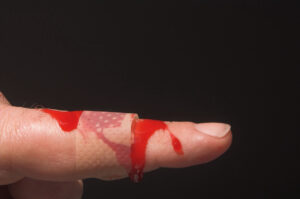 Como Tratar Hemofilia (Doença do sangue na qual a coagulação não se processa ou é extremamente lenta) de Forma Natural e Segura em Casa