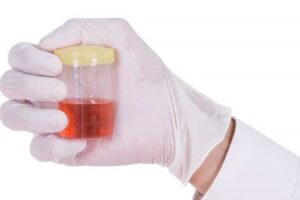 Como Tratar Hematúria (Presença de Sangue na Urina) de Forma Natural e Segura em Casa