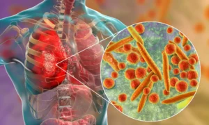 Como Tratar Broncopneumonia de Forma Natural e Segura em Casa