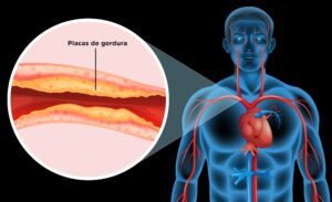 Como Tratar Aterosclerose ou Arteriosclerose de Forma Natural e Segura em Casa