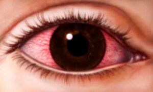 xeroftalmia